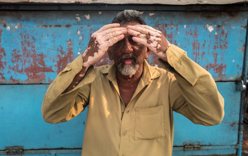 Best Hospital In Bengaluru For Vitiligo Treatment.jpg