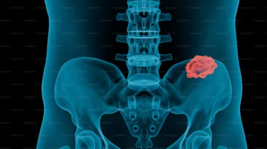 Best Hospital In Delhi For Cervical Spondylosis.jpg